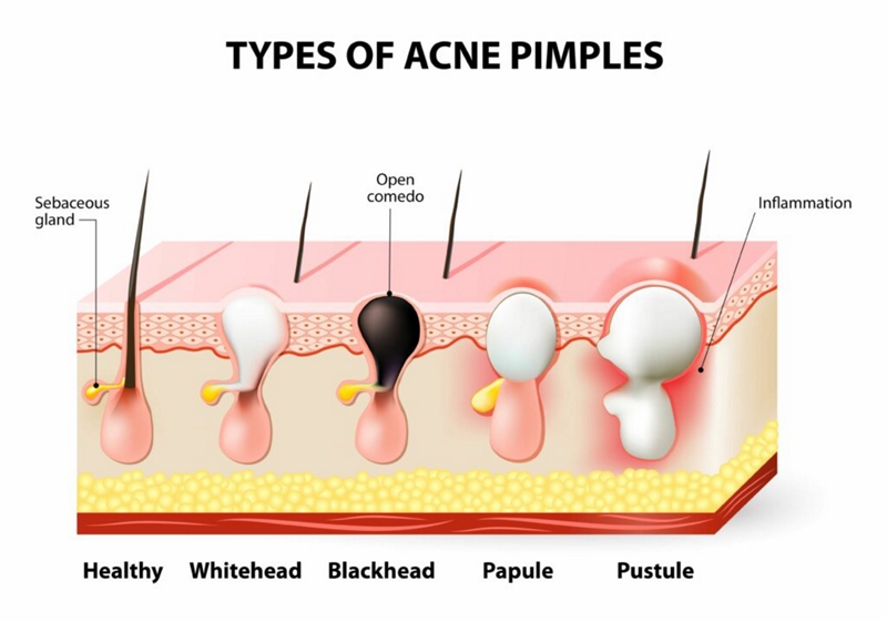 What is a Black Head